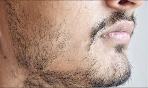 Uneven Beard Growth